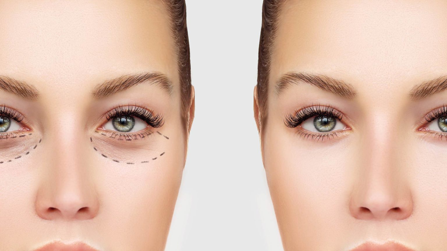 Under Eye Bag Removal Surgery Rajan Uppal Exceptional Care