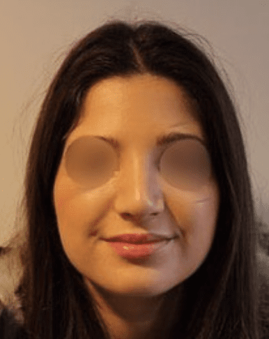 Bump reduction before