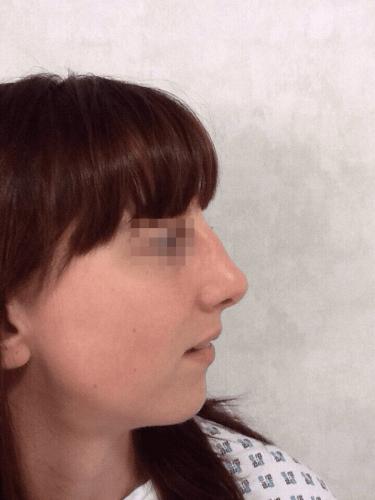 uppal-nose-44-1