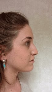 uppal-rhinoplasty-36-169x300