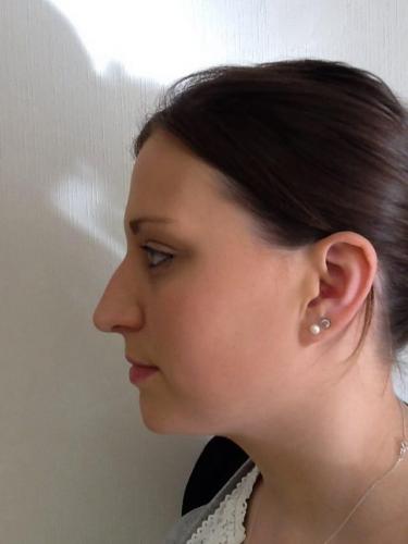 best rhinoplasty surgeon uk